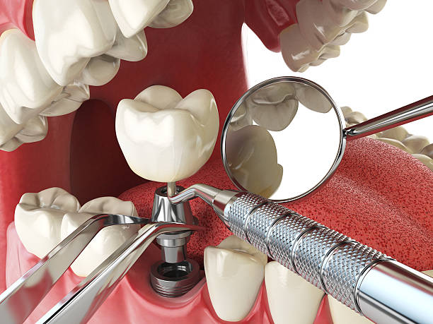 Best Emergency Dentist for Lost Fillings or Crowns in Tornado, WV